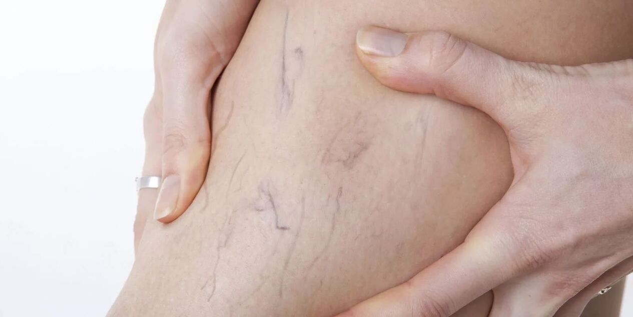 Varicone kreminin kullanılmasından önce